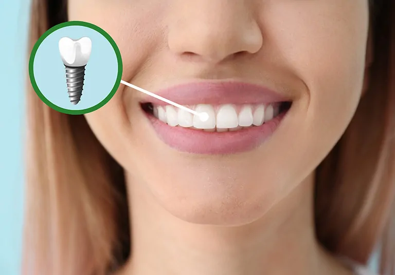 Are Teeth Implants Suitable For Everyone?